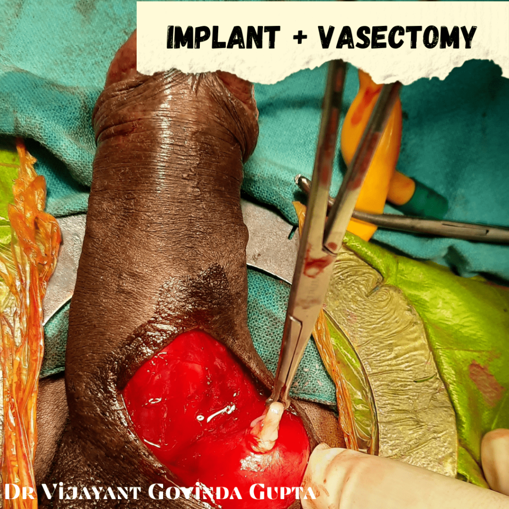 Penile implant with no Scalpel Vasectomy in new delhi india