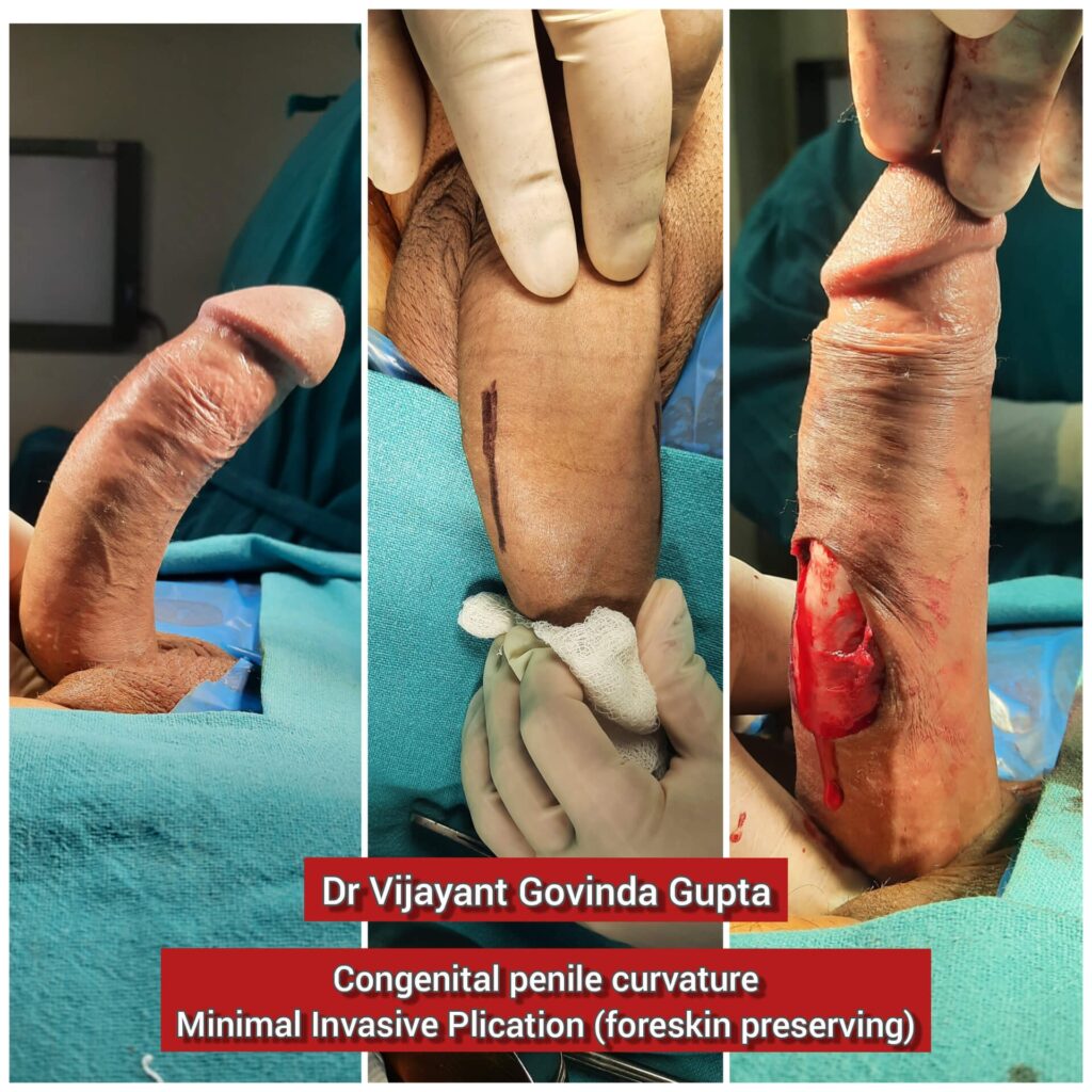 Congenital penile curvature Plication new delhi india dr vijayant govinda gupta