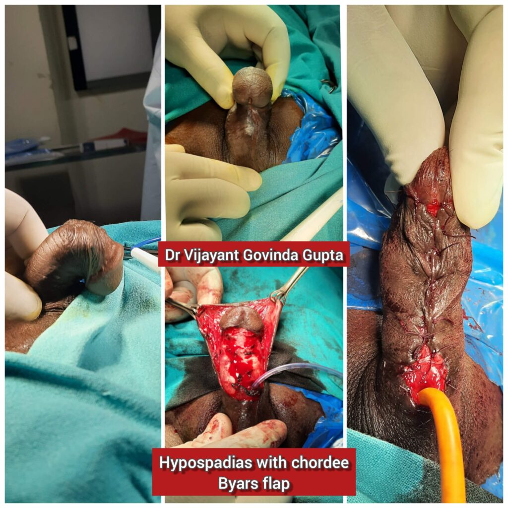 Hypospadias with Penile curvature (chordee) - collage showing repair by Byars flap technique