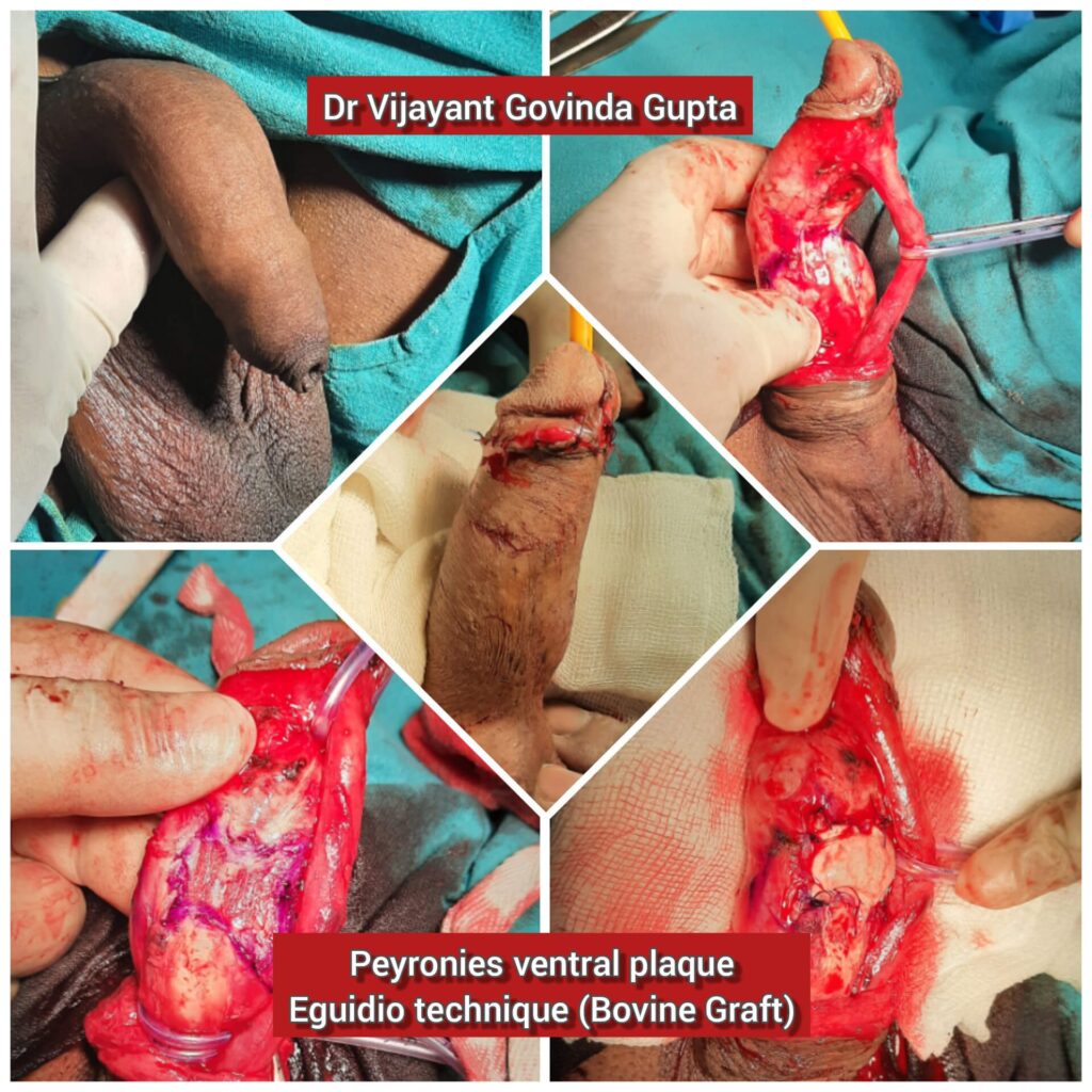 Peyronies disease repair collage - ventral plaque existed and repaired with Bovine pericardial patch