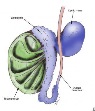 Spermatocele - diagram