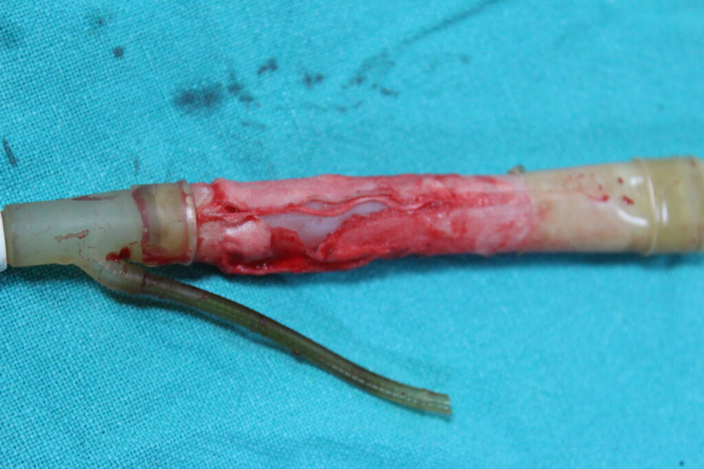 ruptured penile implant - ams 700 malfunction