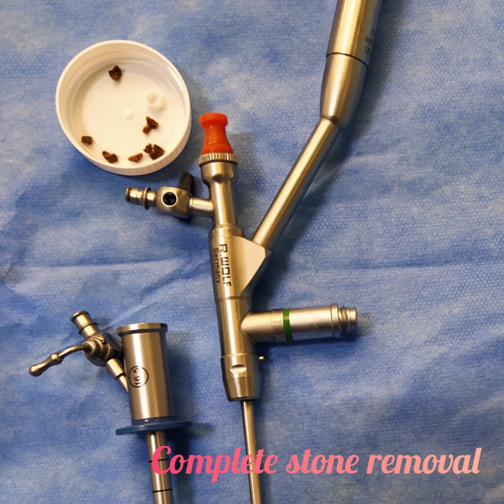 Mini PCNL for Kidney Stone Treatment