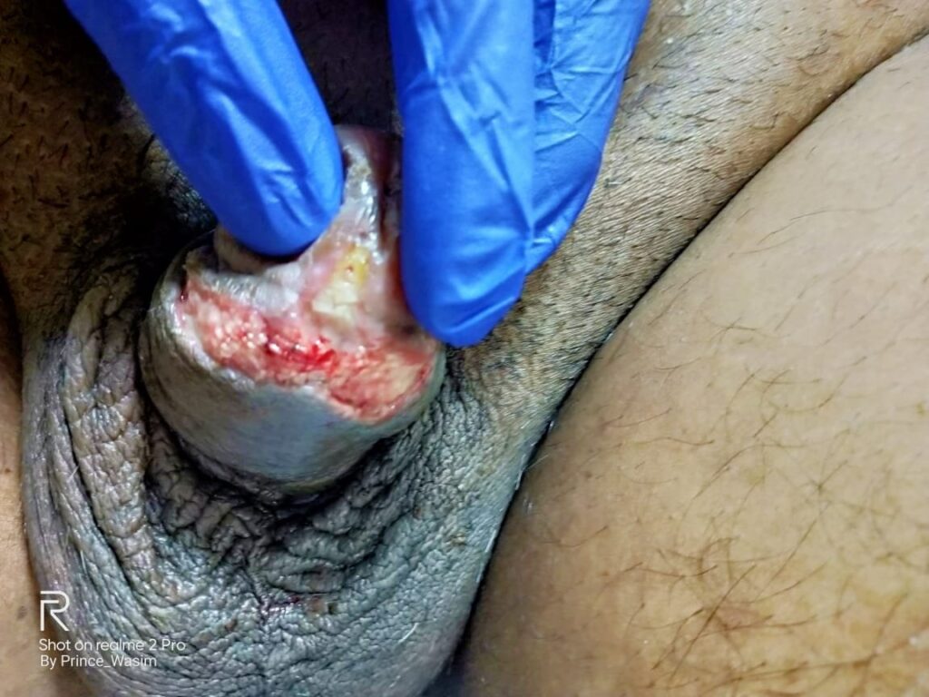 Non healing wound after laser circumcision