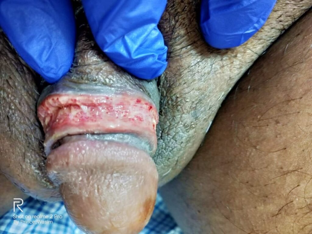 burnt scarred tissue after laser circumcision