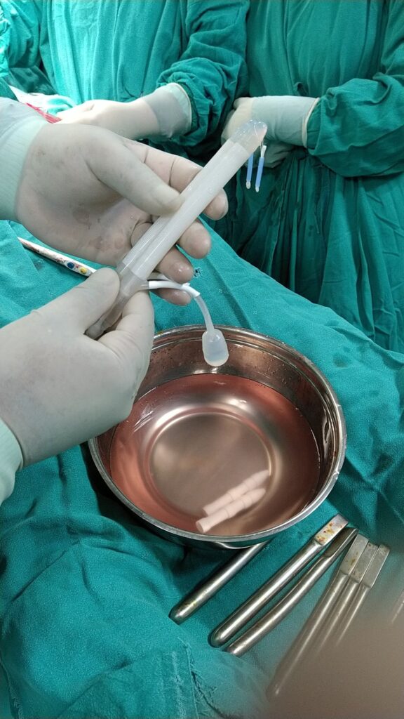 Dr Vijayant Govinda gupta holds the AMS Ambicor Implant | AMS Boston Scientific Ambicor 2 piece Intra penile Prosthesis New Delhi India