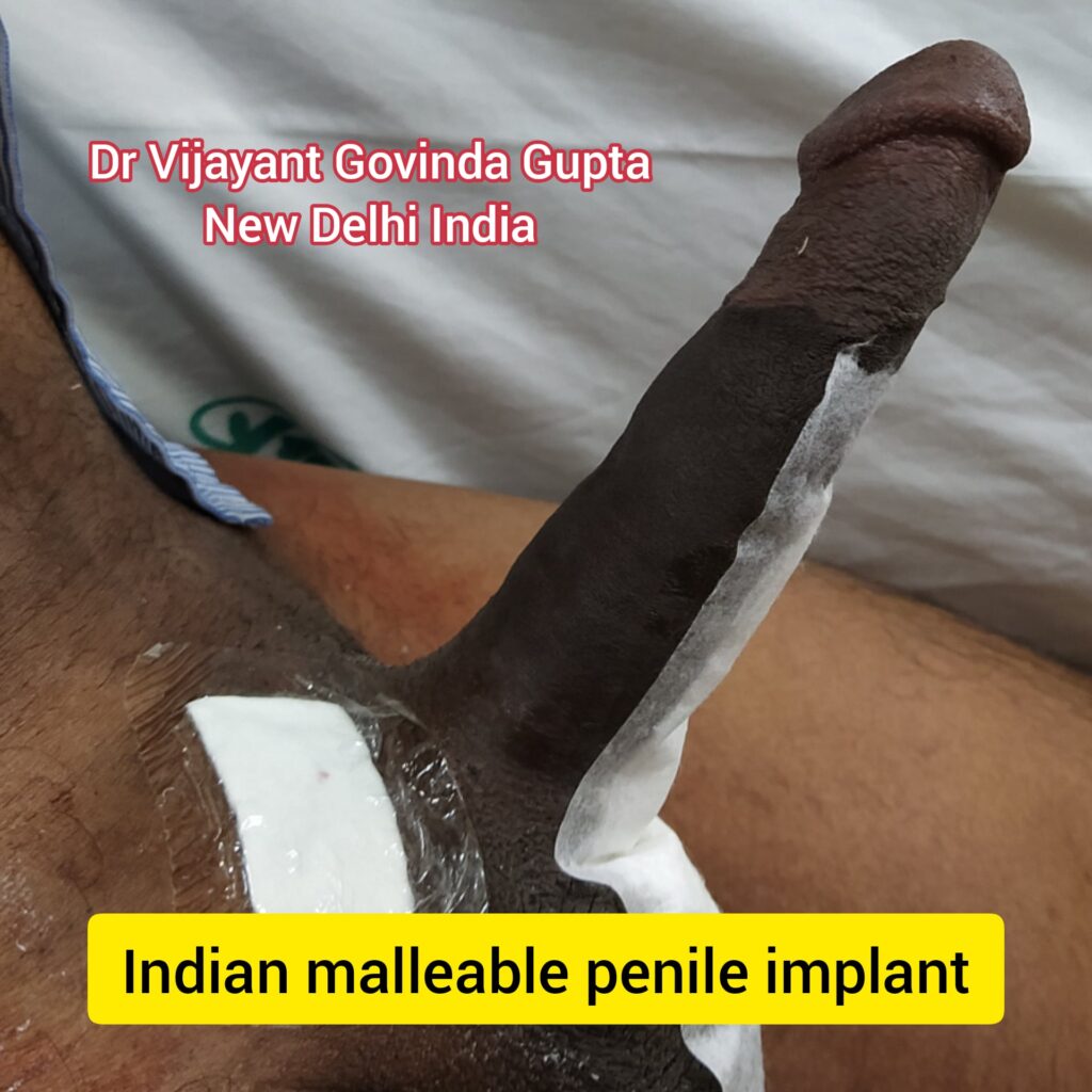 3000 USD penile implant | cheapest penile implant in the world | indian semirigid penile implant