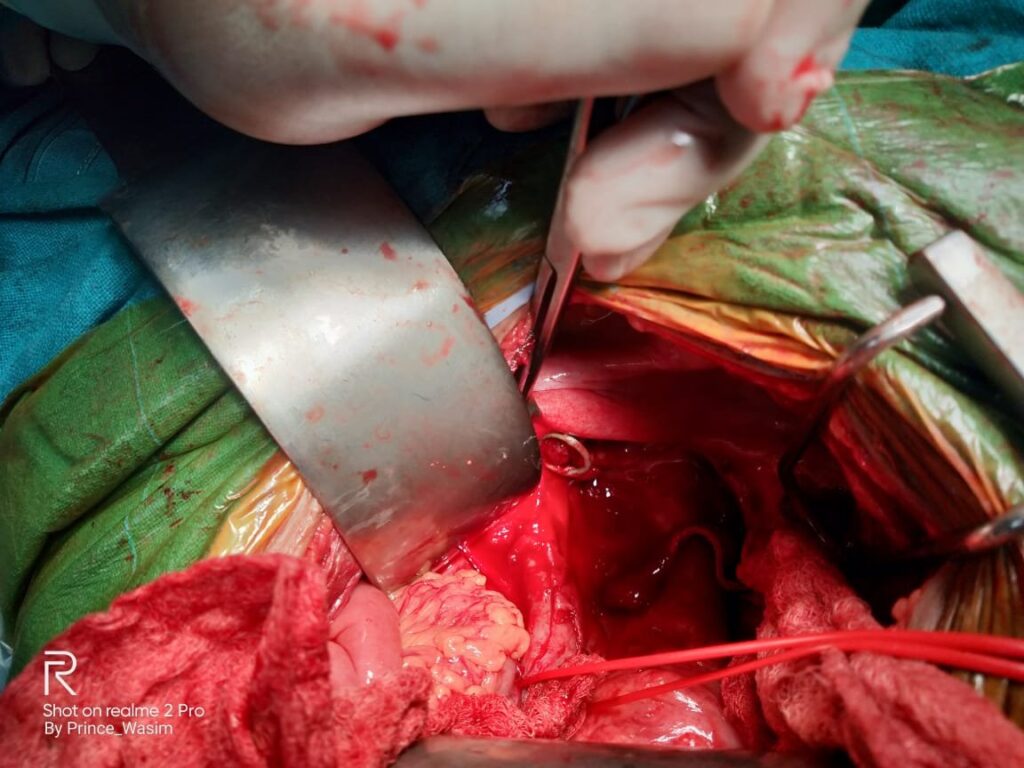 Ureteric DJ stent in ureter seen in vagina | Ureterovaginal fistula