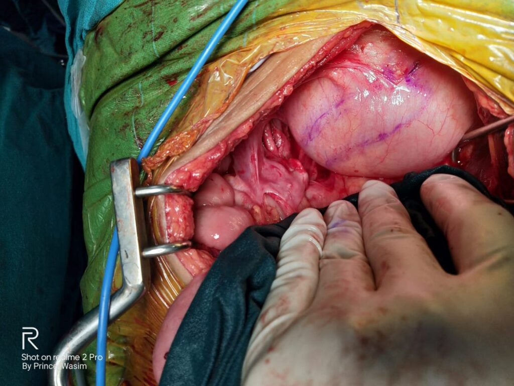 Marking of Baori Flap on Urinary bladder | Repair of Ureterovaginal fistula (UVF) in New Delhi India