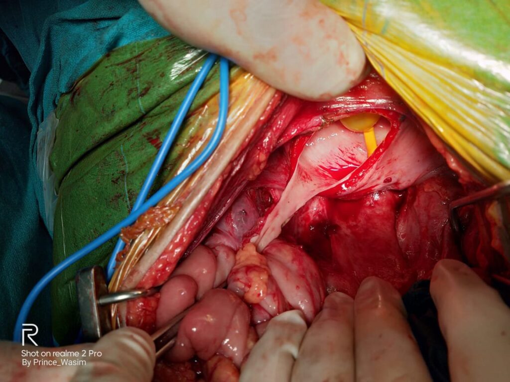 Baori flap extending to neoureter opening - before closing uretero vaginal (UVF) fistula