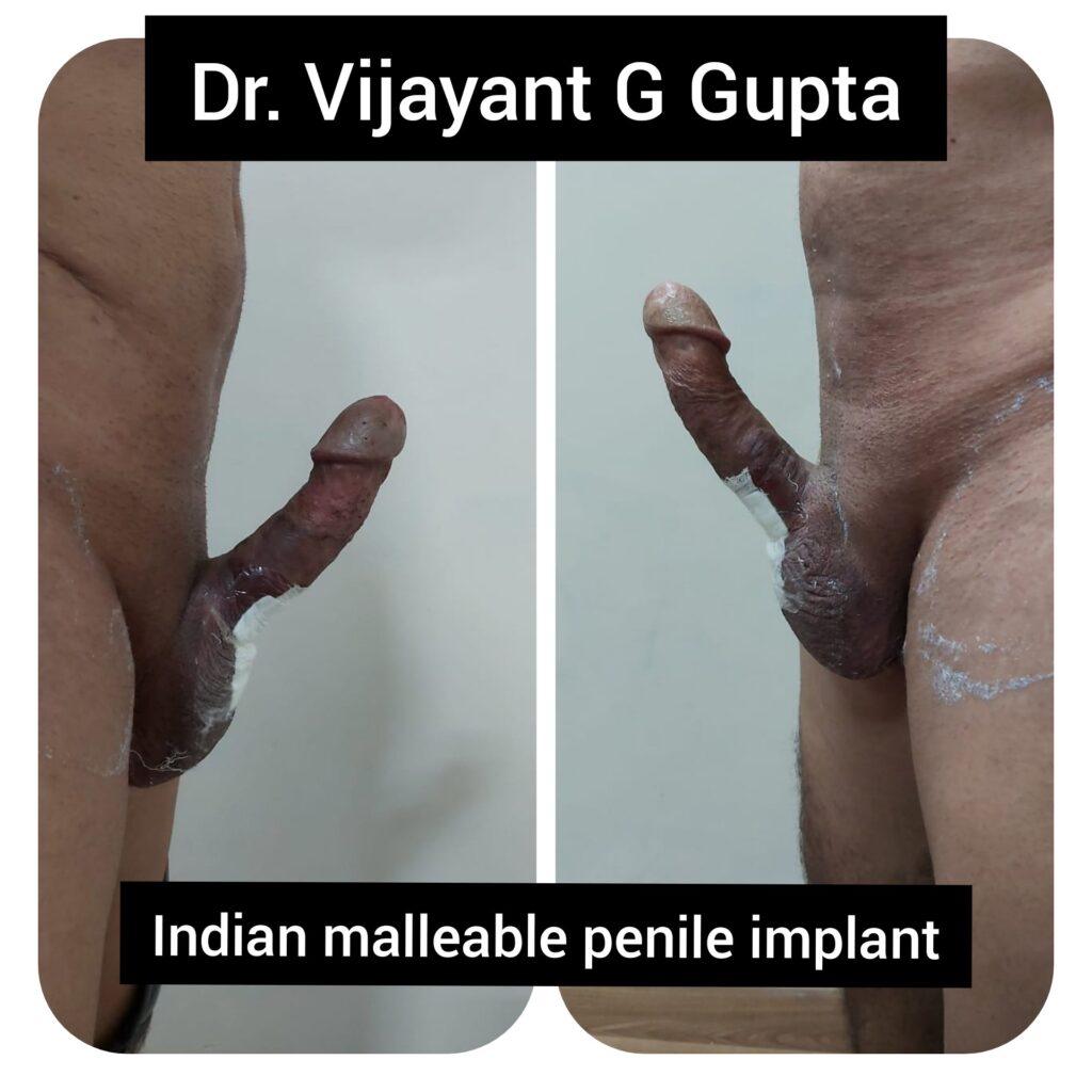 Grandpa penile implant videos