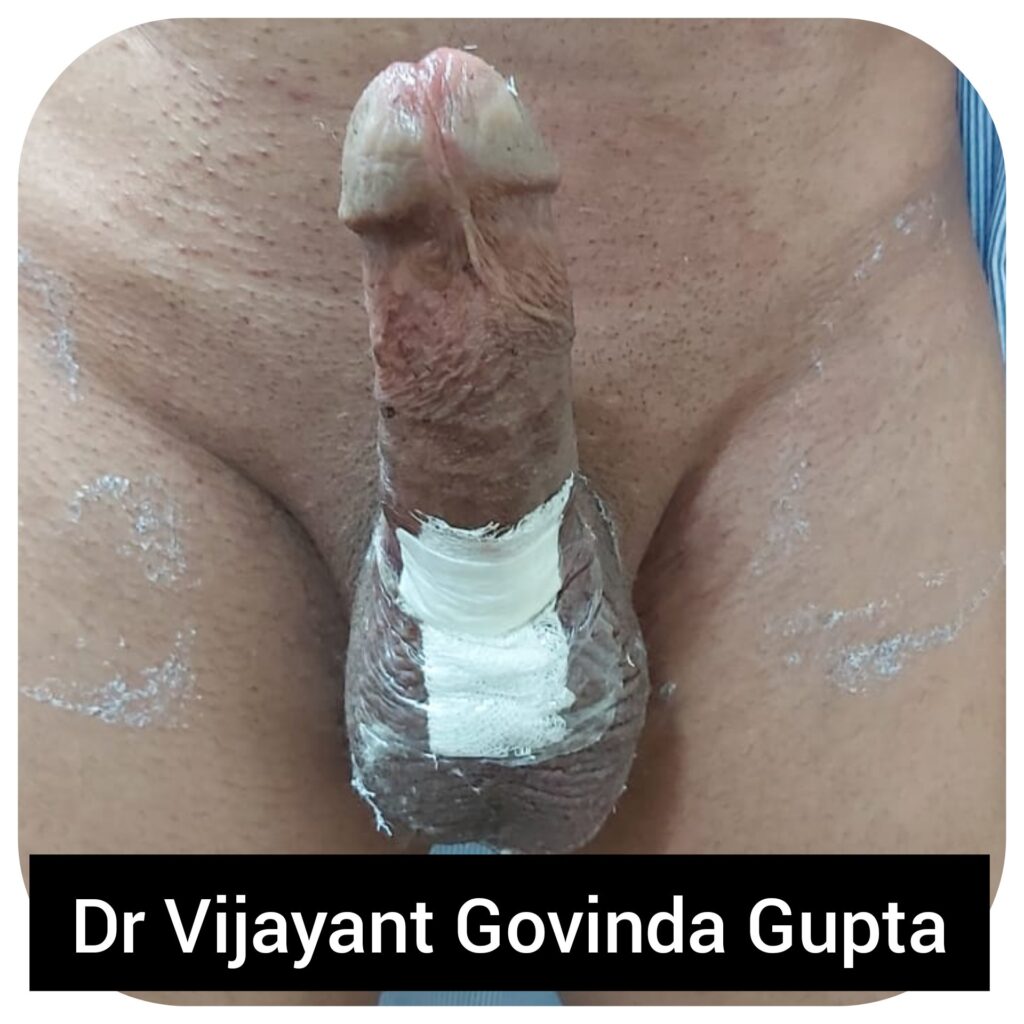 Patient on Post Operative Day 1 (24 hours) after his Indian Penile Implant Surgery