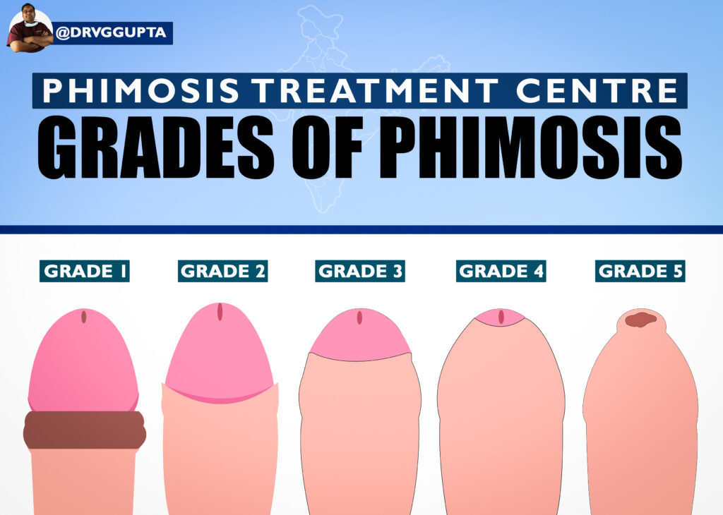 Grades of Phimosis