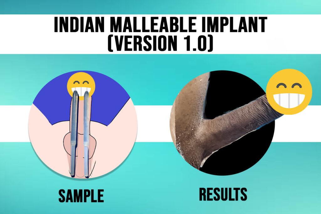 Indian Malleable Penile Implant 1.0