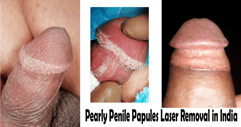 Pearly Penile Papules Laser Removal in India
