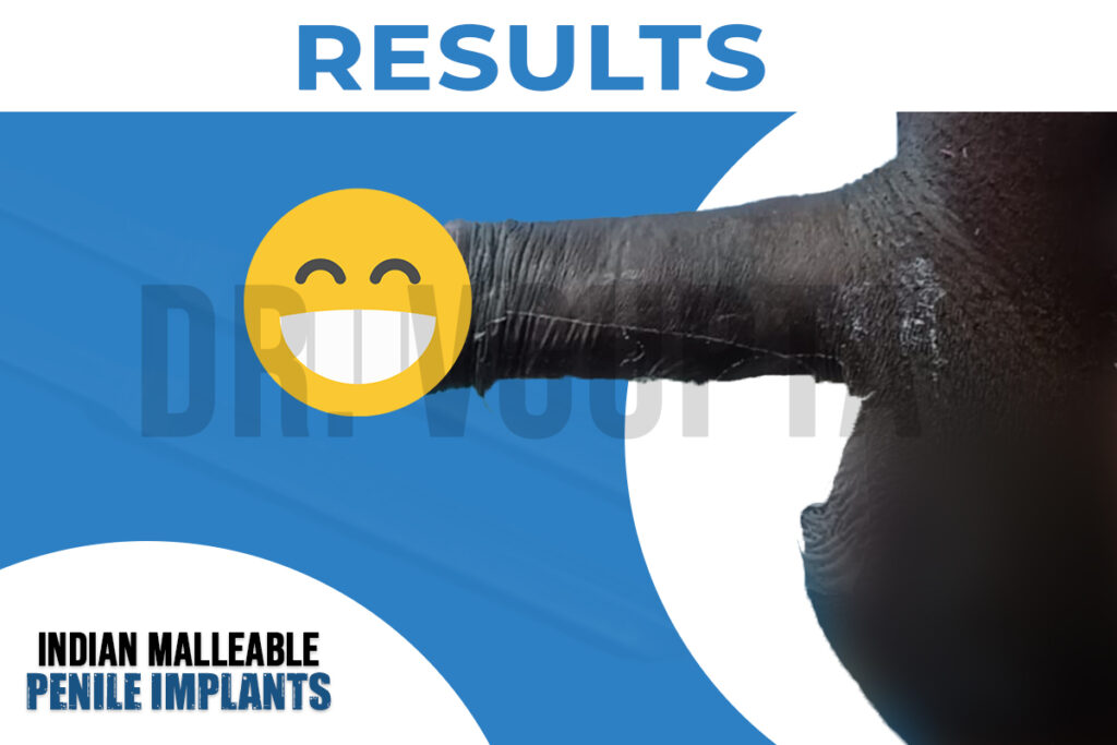 Indian Malleable Penile Implant Result 2