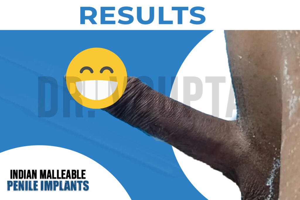 Indian Malleable Penile Implant Result 3