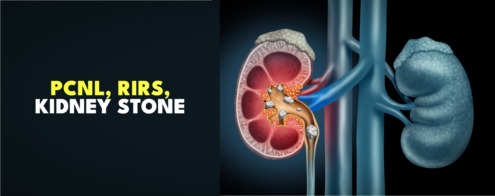 pcnl-riris-kidney-sotnes TREATMENTS