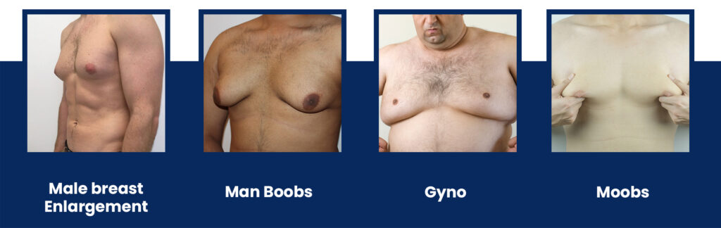 Common Synonyms of Gynecomastia