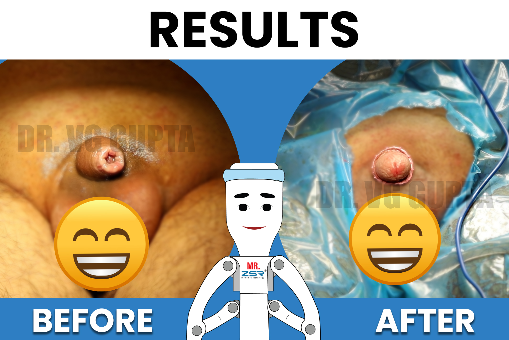 BEFORE-AFTER-zsr-results-4