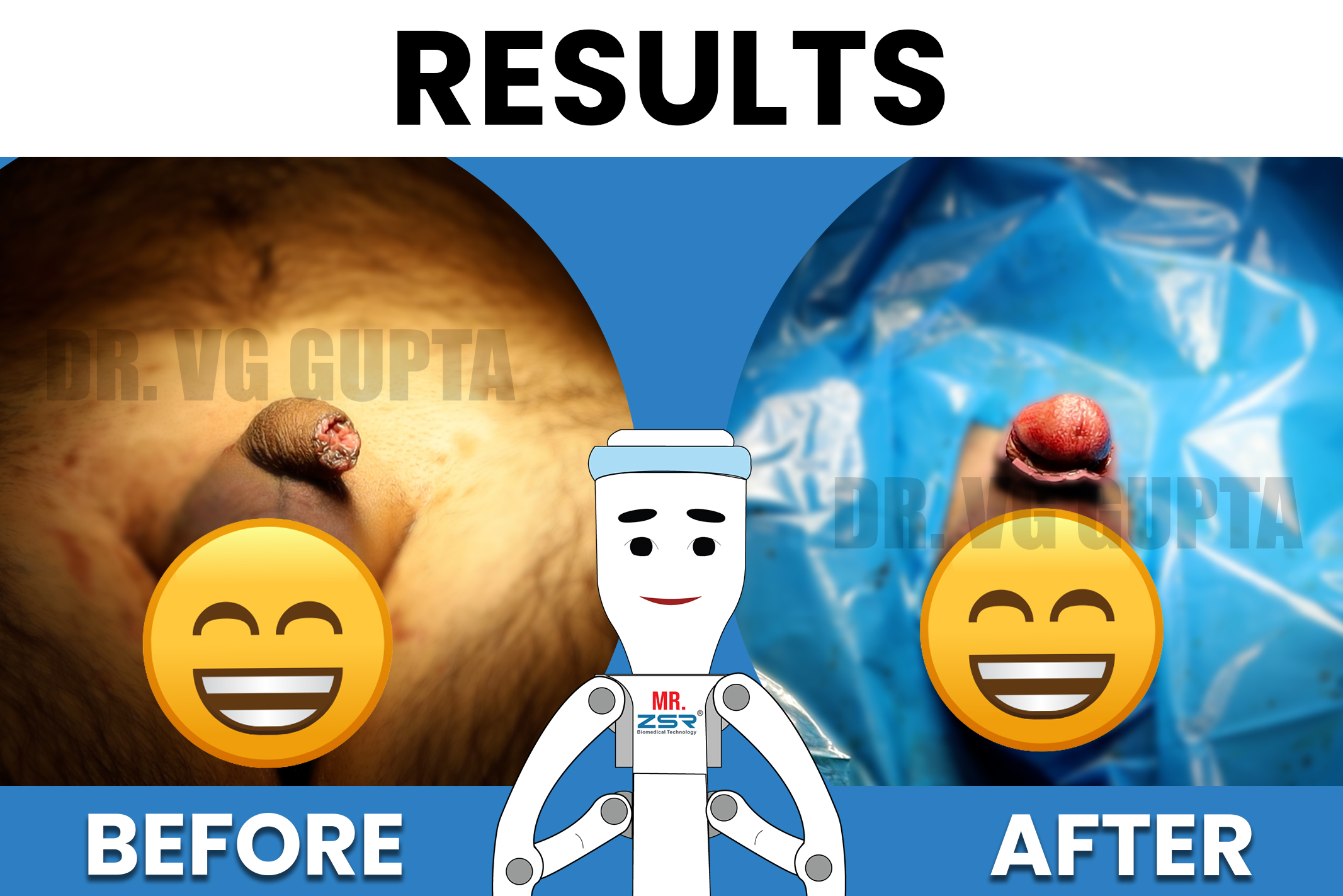 before-after-zsr-results-5