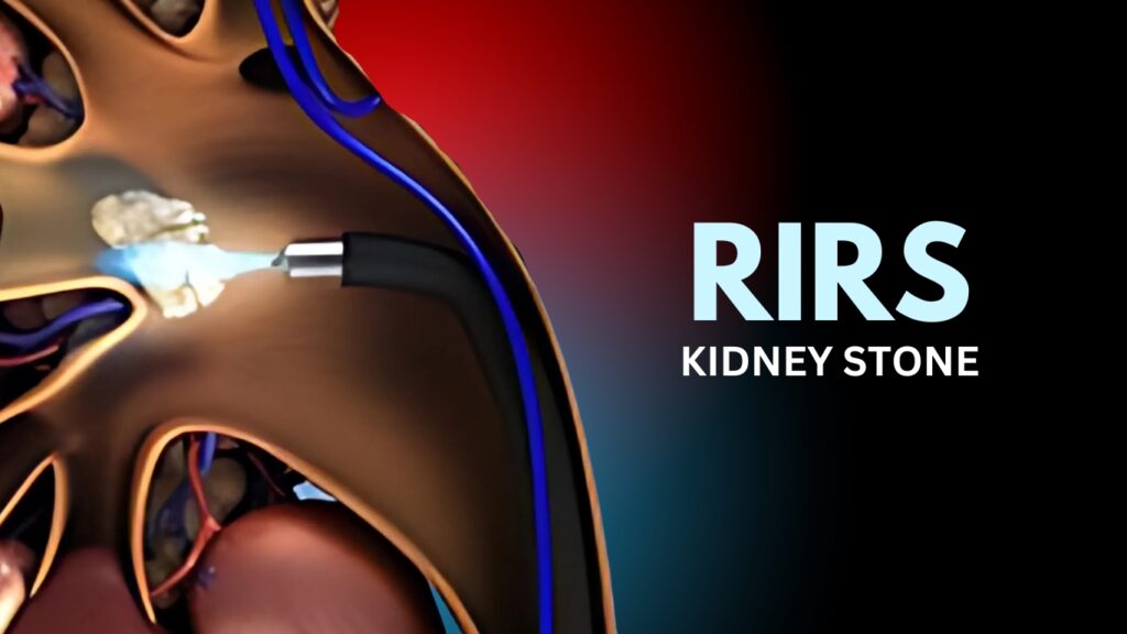 RIRS Surgery in delhi