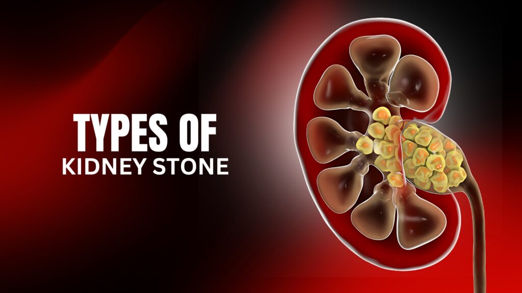 types of kidney stones