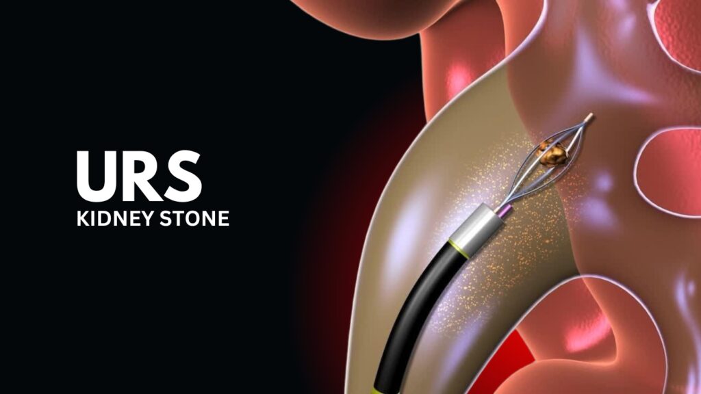 URS Surgery for Kidney Stone